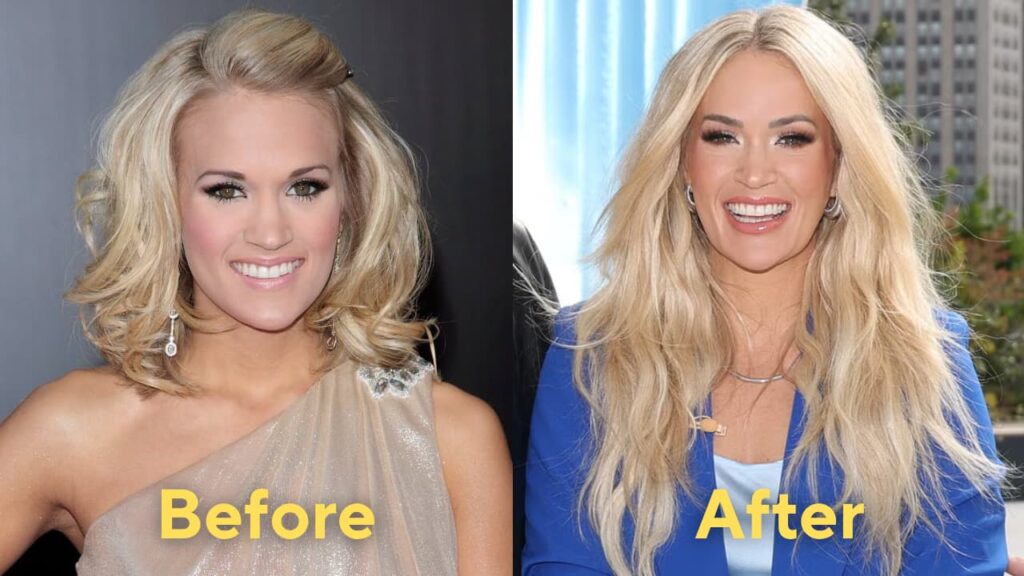 has carrie underwood had plastic surgery