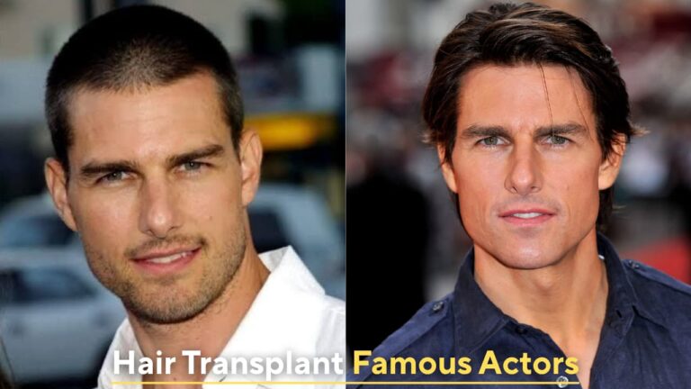 hair transplant famous actors