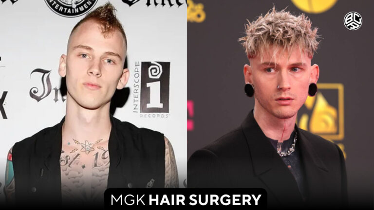 mgk hair surgery