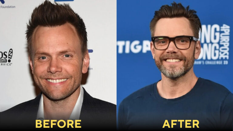 joel mchale hair implants